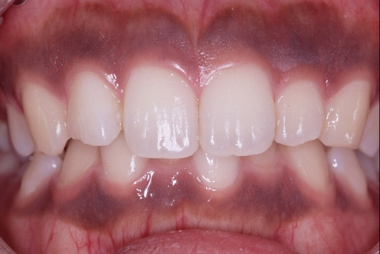 健康的なピンク色へ「歯ぐきのメラニン除去」