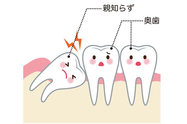 親知らず抜歯